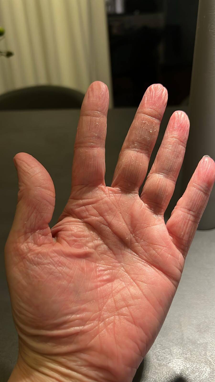 Gesunde Haut nach Neurodermitis-Behandlung langfristiger Erfolg November 2025 Gesunde Haut nach Neurodermitis-Behandlung - langfristiger Erfolg November 2025