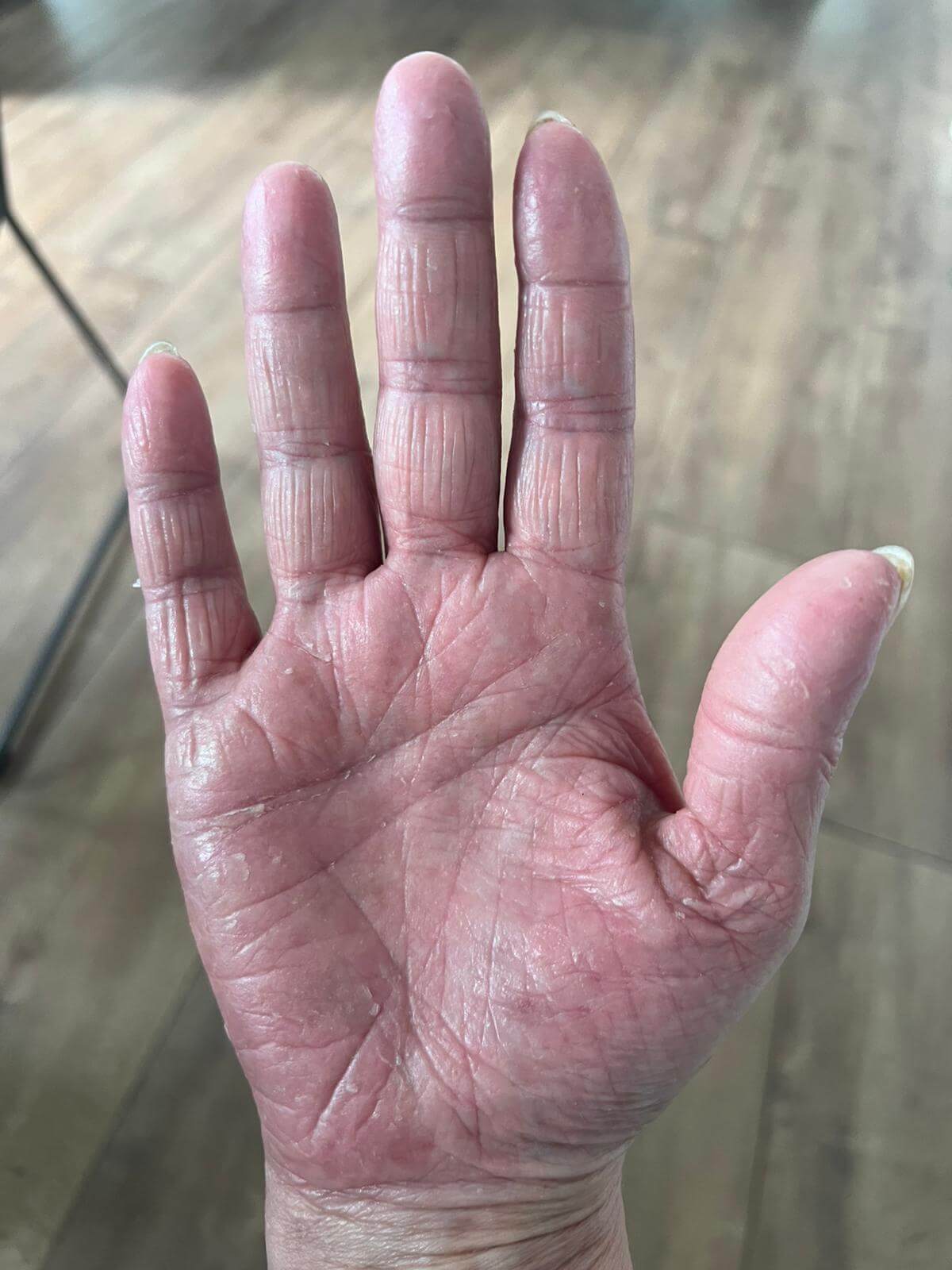 Neurodermitis Behandlung Juli 2025 Entzündungen klingen ab Neurodermitis Behandlung Juli 2025 - Entzündungen klingen ab