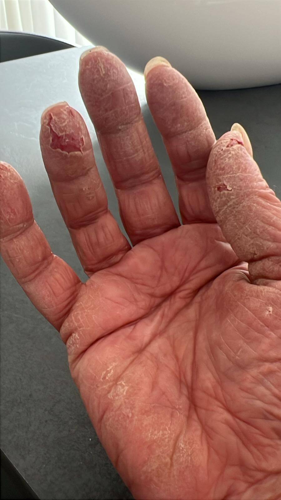 Neurodermitis Hände Juni 2025 erste Verbesserungen nach 4 Wochen Behandlung Neurodermitis Hände Juni 2025 - erste Verbesserungen nach 4 Wochen Behandlung