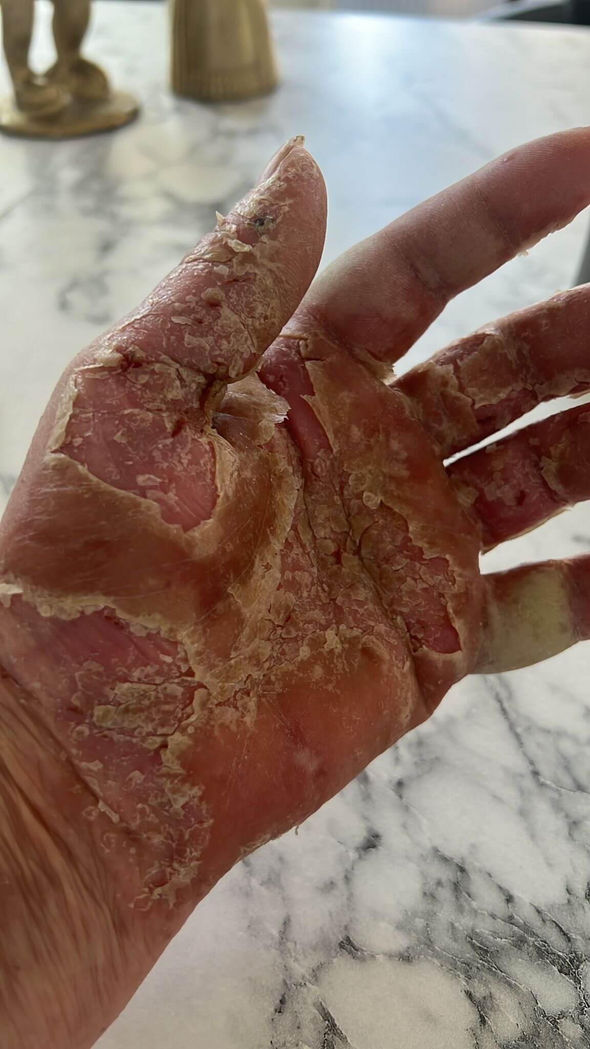 Neurodermitis Hände Mai 2025 Ausgangssituation mit starker Schuppung und Entzündung Neurodermitis Hände Mai 2025 - Ausgangssituation mit starker Schuppung und Entzündung