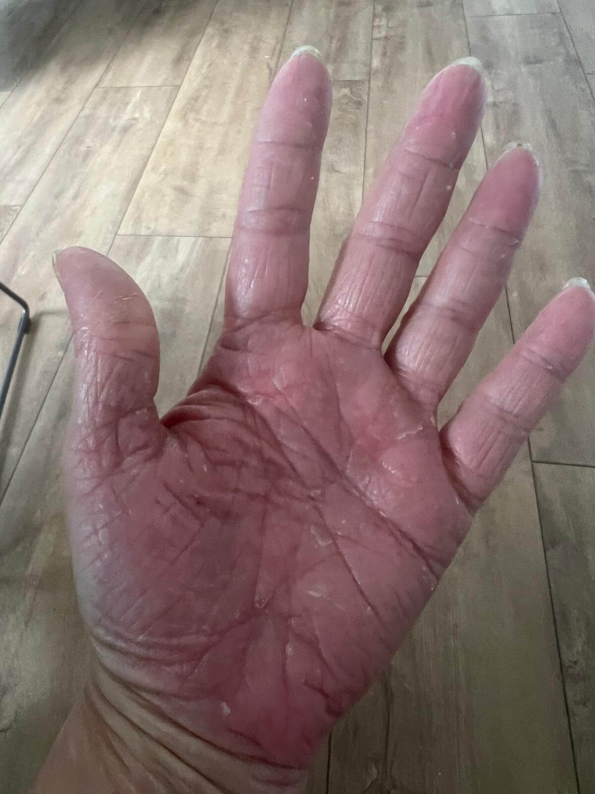 Neurodermitis Heilung Juli 2025 deutliche Verbesserung der Hautstruktur Neurodermitis Heilung Juli 2025 - deutliche Verbesserung der Hautstruktur