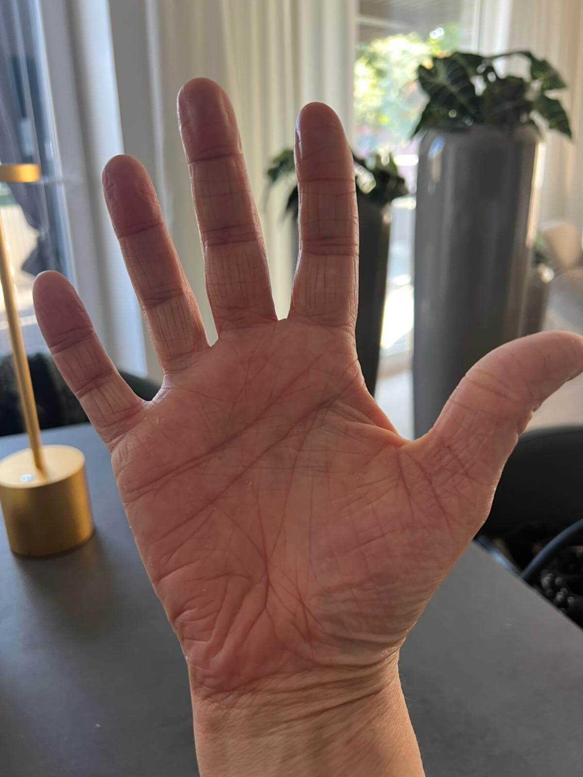 Neurodermitis Heilung ohne Cortison vollständige Abheilung nach 4 Monaten August 2025 Neurodermitis Heilung ohne Cortison - vollständige Abheilung nach 4 Monaten August 2025