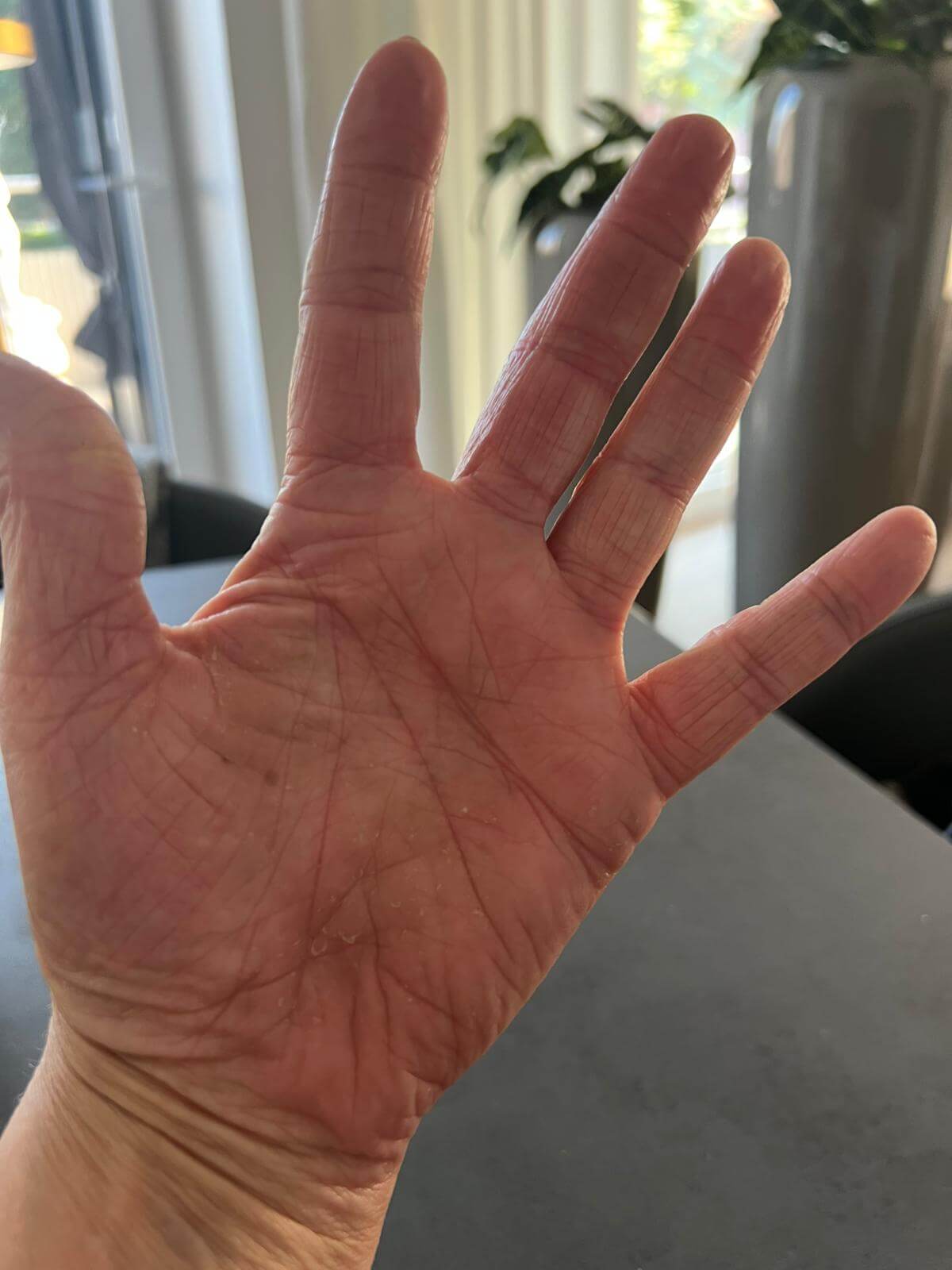 Neurodermitis vollständig geheilt August 2025 gesunde Hände ohne Entzündung Neurodermitis vollständig geheilt August 2025 - gesunde Hände ohne Entzündung