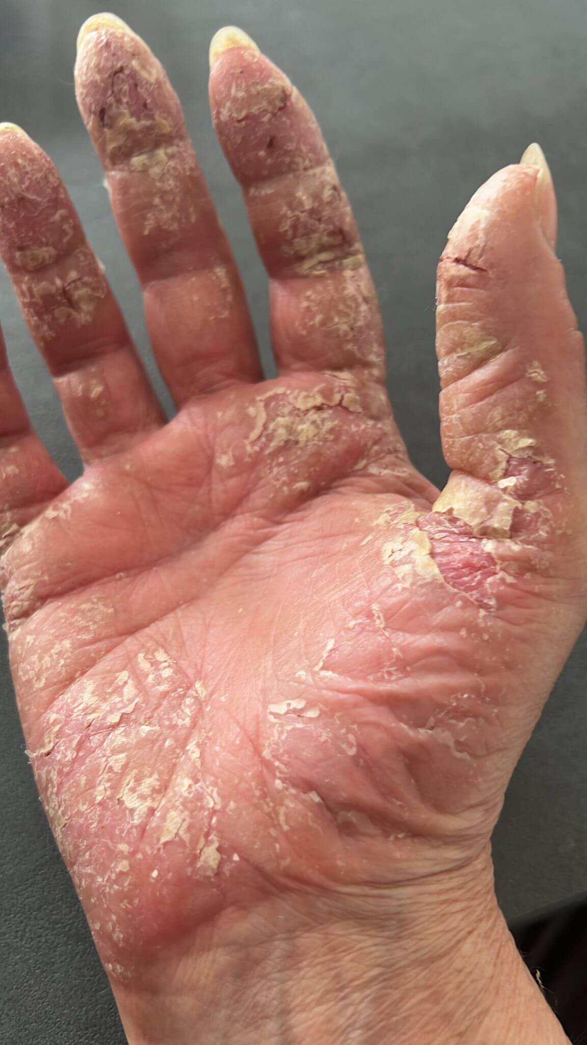 Schwere Neurodermitis an den Händen Ausgangszustand vor der Behandlung Mai 2025 Schwere Neurodermitis an den Händen - Ausgangszustand vor der Behandlung Mai 2025
